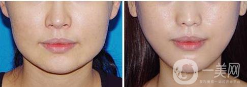 *一針多少錢,**價格