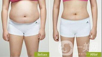 環(huán)形吸脂價格