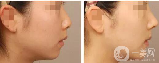 耳軟骨隆鼻