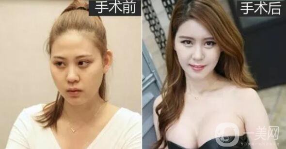 顴骨內(nèi)推術(shù)