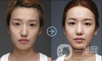 面部脂肪填充維持多久