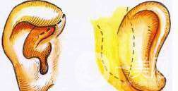 什么是側(cè)耳成形術(shù) 側(cè)耳成形術(shù)的操作流程