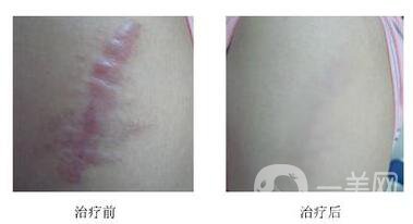 修復(fù)疤痕,激光祛疤