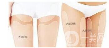 雙腿環(huán)形吸脂多少錢