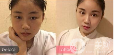 光纖溶脂價格 光纖溶脂瘦臉*果好嗎?