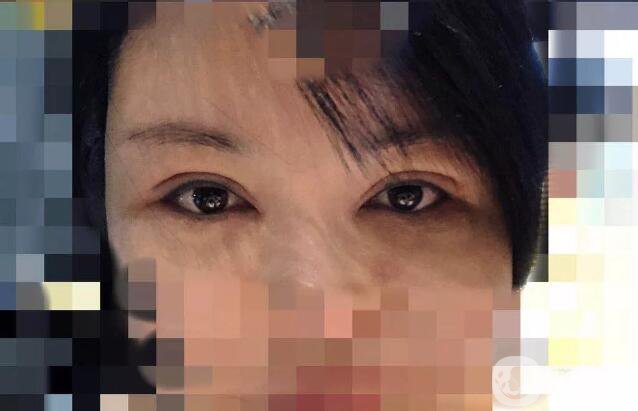 處楊曉楠雙眼皮案例 楊曉楠醫(yī)生怎么樣？