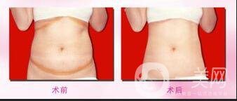 360環(huán)形吸脂,價(jià)格,多少錢,費(fèi)用