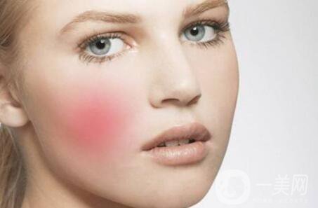 北京激光去紅血絲多少錢?