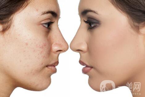 黑臉娃娃去痘*果好嗎？黑臉娃娃功*介紹