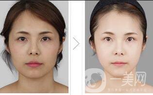 面部纖維溶解手術