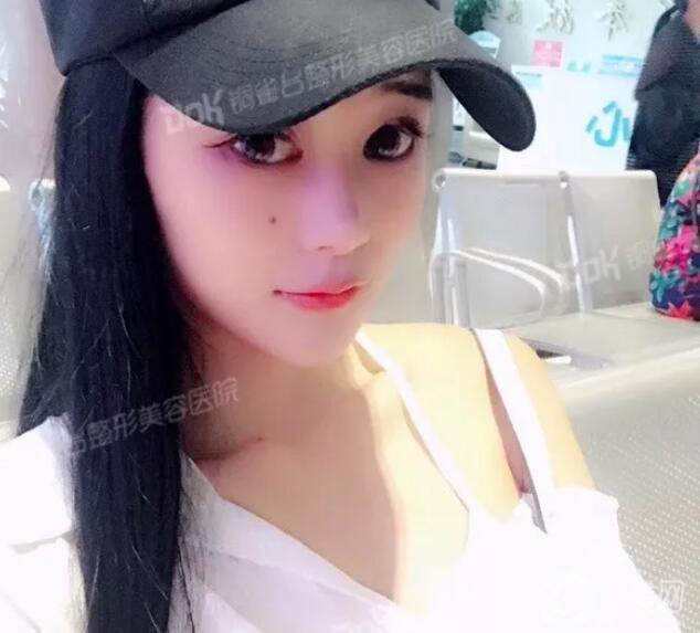 自體脂肪填充臉真人案例：路人到仙女的蛻變