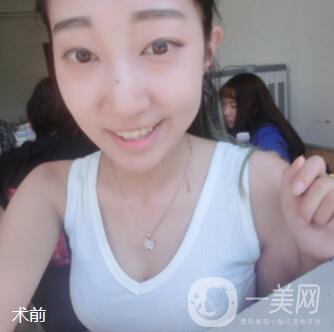 脂肪隆胸手術真實經(jīng)歷：過來人說說從A到C的改變