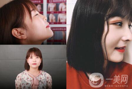 隆鼻前后照片分析 專(zhuān)家解析：隆鼻前后的變化