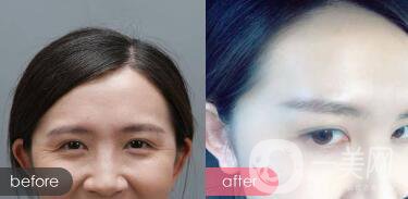 *對魚尾紋的作用：注射部位和副作用