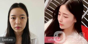 綜合鼻整形多少錢？綜合鼻整形收費(fèi)