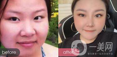 蒜頭鼻整形圖片 蒜頭鼻整形多少錢？