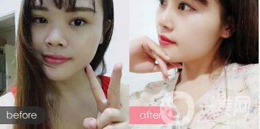 蒜頭鼻整形圖片 蒜頭鼻整形多少錢？