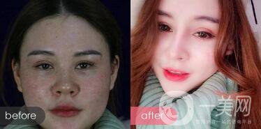 注射隆鼻整形多少要錢？微整形注射隆鼻過程