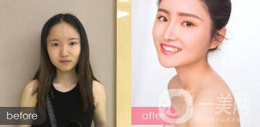 注射隆鼻整形多少要錢？微整形注射隆鼻過程