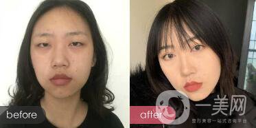 成都開(kāi)眼角多少錢呢？開(kāi)眼角案例