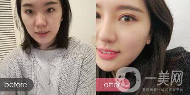 成都開(kāi)眼角多少錢呢？開(kāi)眼角案例