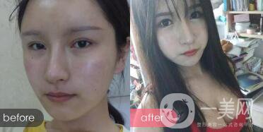 成都開(kāi)眼角多少錢呢？開(kāi)眼角案例