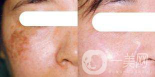 激光除斑要幾天才好 激光除斑多久可以洗臉呢