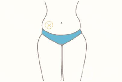 360度環(huán)形吸脂好不好 是全麻還是局麻