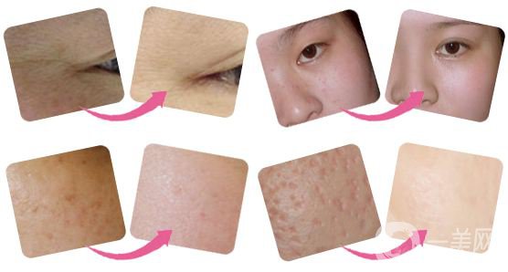 光子嫩膚后注意事項 多久做一次呢