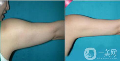 成都抽脂減肥價格多少