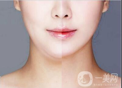 面部吸脂恢復(fù)