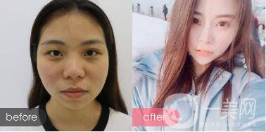 *手術(shù)恢復(fù)多久？多久可以拆線？