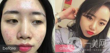 果酸祛痘*果嗎 果酸祛痘有什么好處？