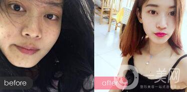 果酸祛痘*果嗎 果酸祛痘有什么好處？