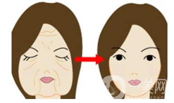 電波拉皮除皺術要做幾次 有人做過電波拉皮嗎