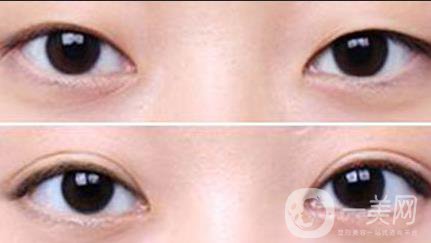 不開(kāi)刀的雙眼皮