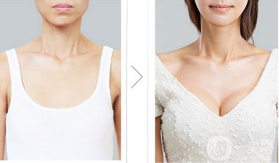 脂肪填充隆胸*果如何