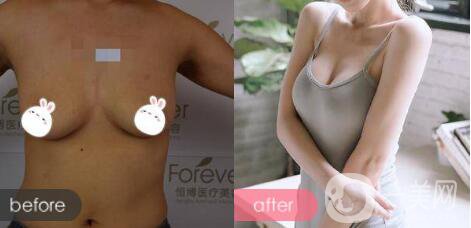自體脂肪隆胸
