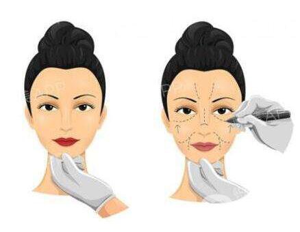 電波拉皮除皺術(shù)5年后*果還有嗎