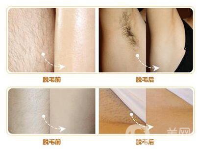 什么是激光脫毛？激光脫毛的優(yōu)勢(shì)有哪些？