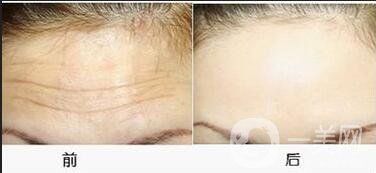 抬頭紋能消除嗎