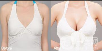 自體脂肪隆胸有風(fēng)險(xiǎn)嗎