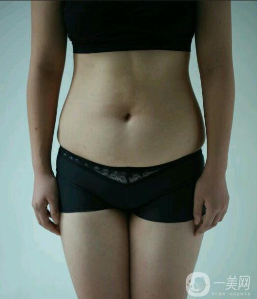 水動力吸脂親身經(jīng)歷