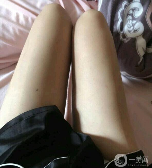 水動力吸脂親身經(jīng)歷