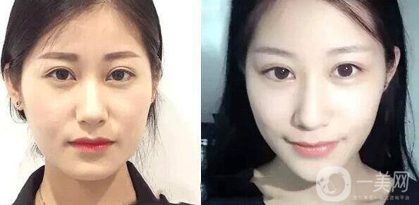 在成都注射*貴嗎 需要多少錢