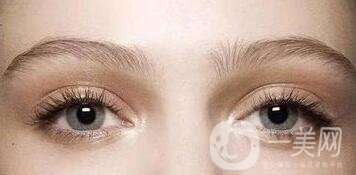 歐式雙眼皮多少錢