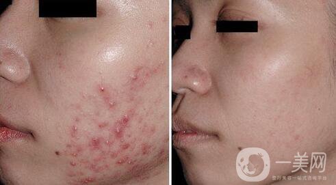 果酸換膚多少錢