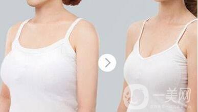 乳房縮小手術(shù)