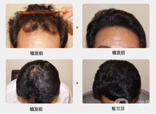 什么是植發(fā)手術？脫發(fā)的主要原因？