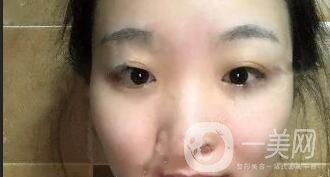 開眼角價(jià)格